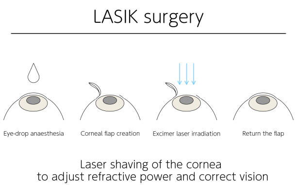 The Lasik procedure